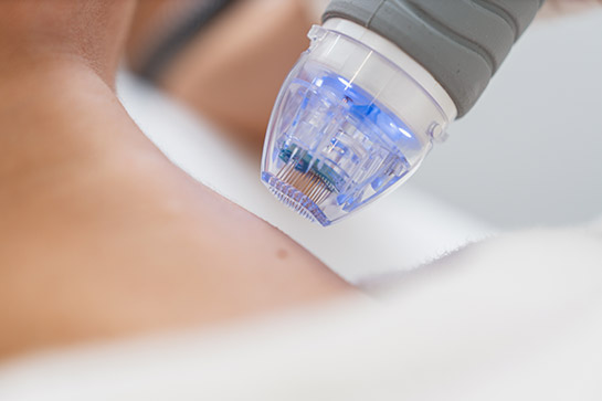 Cabezar microagujas tratamiento dermatológico