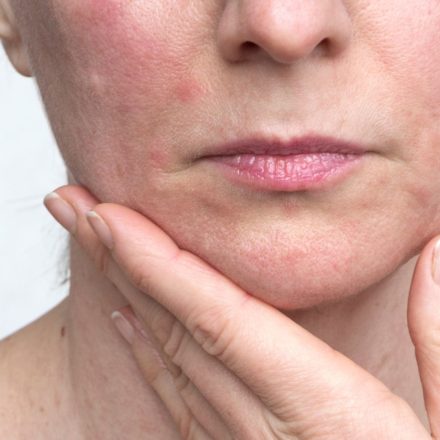 Dermatitis perioral: causas y tratamiento