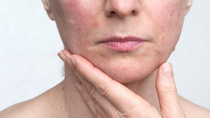 Dermatitis perioral: causas y tratamiento