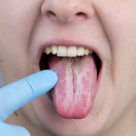 Causas de la candidiasis oral