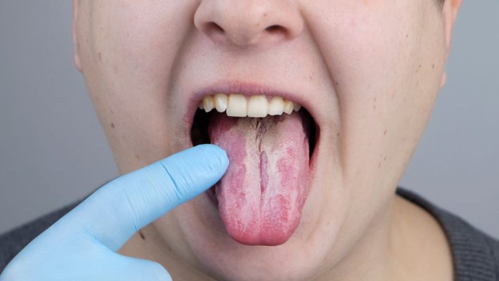 Causas de la candidiasis oral