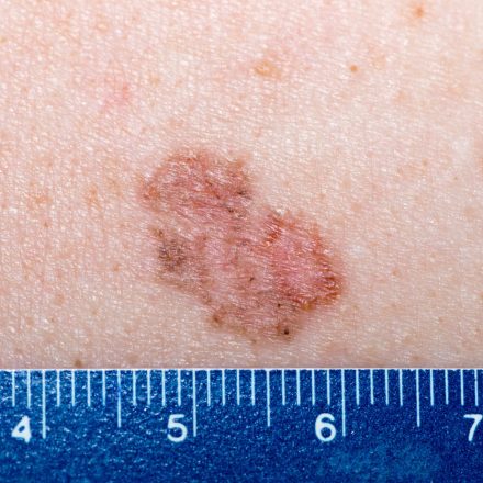 Tratamiento del carcinoma basocelular