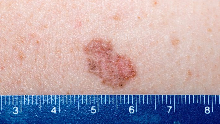 Tratamiento del carcinoma basocelular Tratamiento del carcinoma basocelular