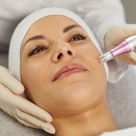 Microneedling, la técnica que transforma el cuidado de la piel desde dentro