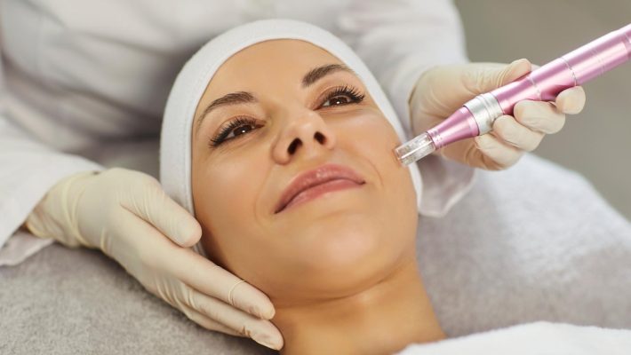 Microneedling, la técnica que transforma el cuidado de la piel desde dentro